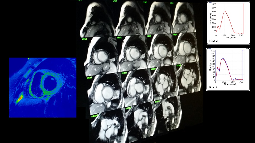 Looks at blood flow to the heart both at rest and under stress